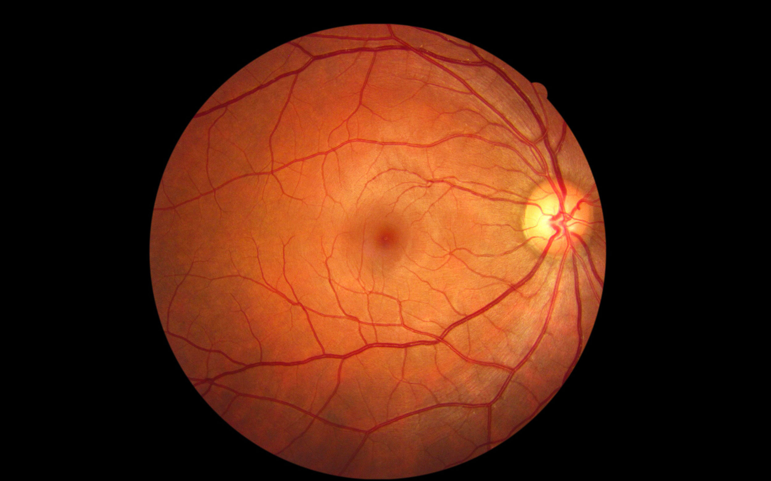 Eye Disease/Disorder EyeDentity Eyecare + Eyewear